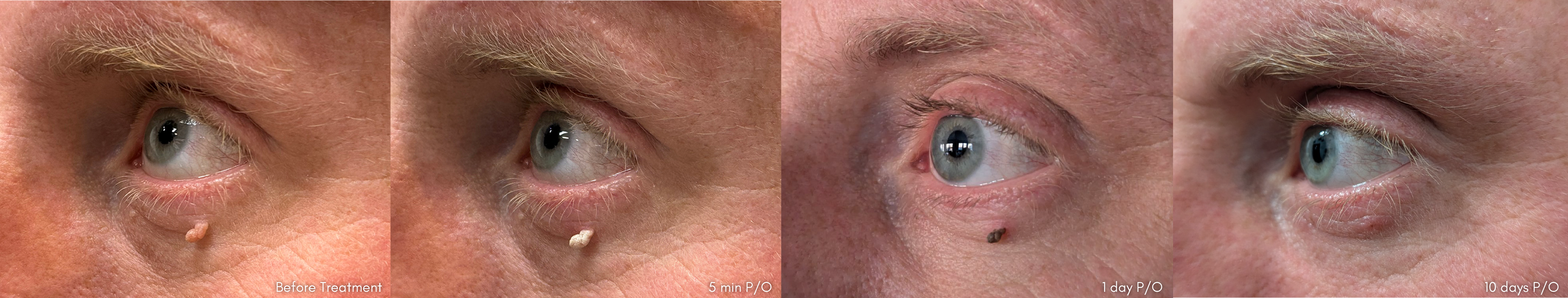 Medical professional using Derma Cautery™ Kit for skin lesion removal